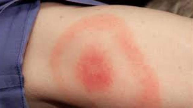 La erupción en la piel es muy notoria tras la picadura. Foto: La Nación GDA