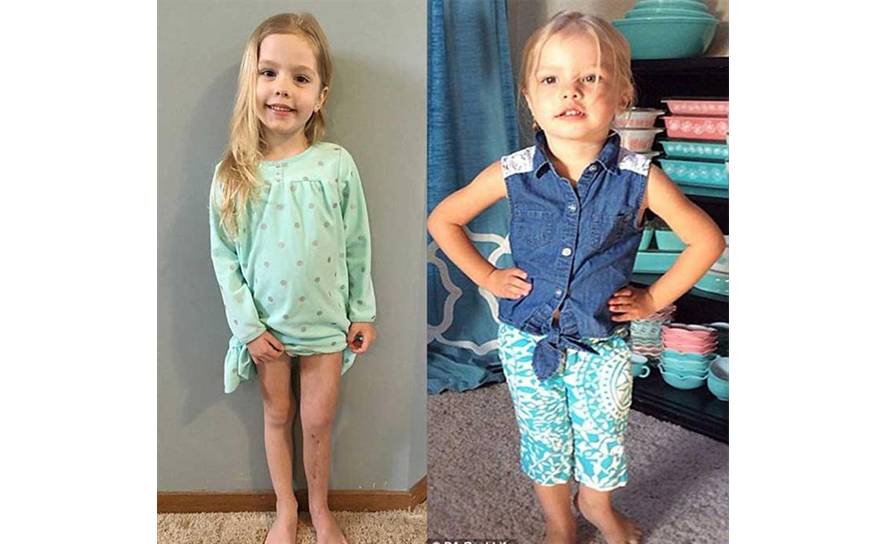 El tratamiento fue muy doloroso para madre e hija, pero funcionó. Foto: PA Real Life.