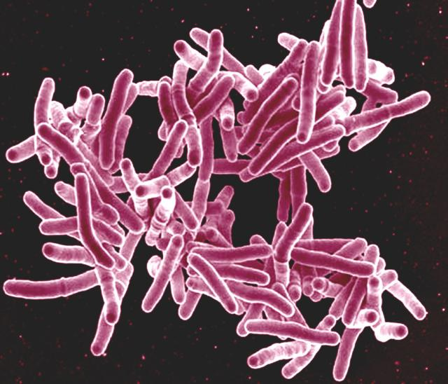 Tuberculosis. Foto: Flickr