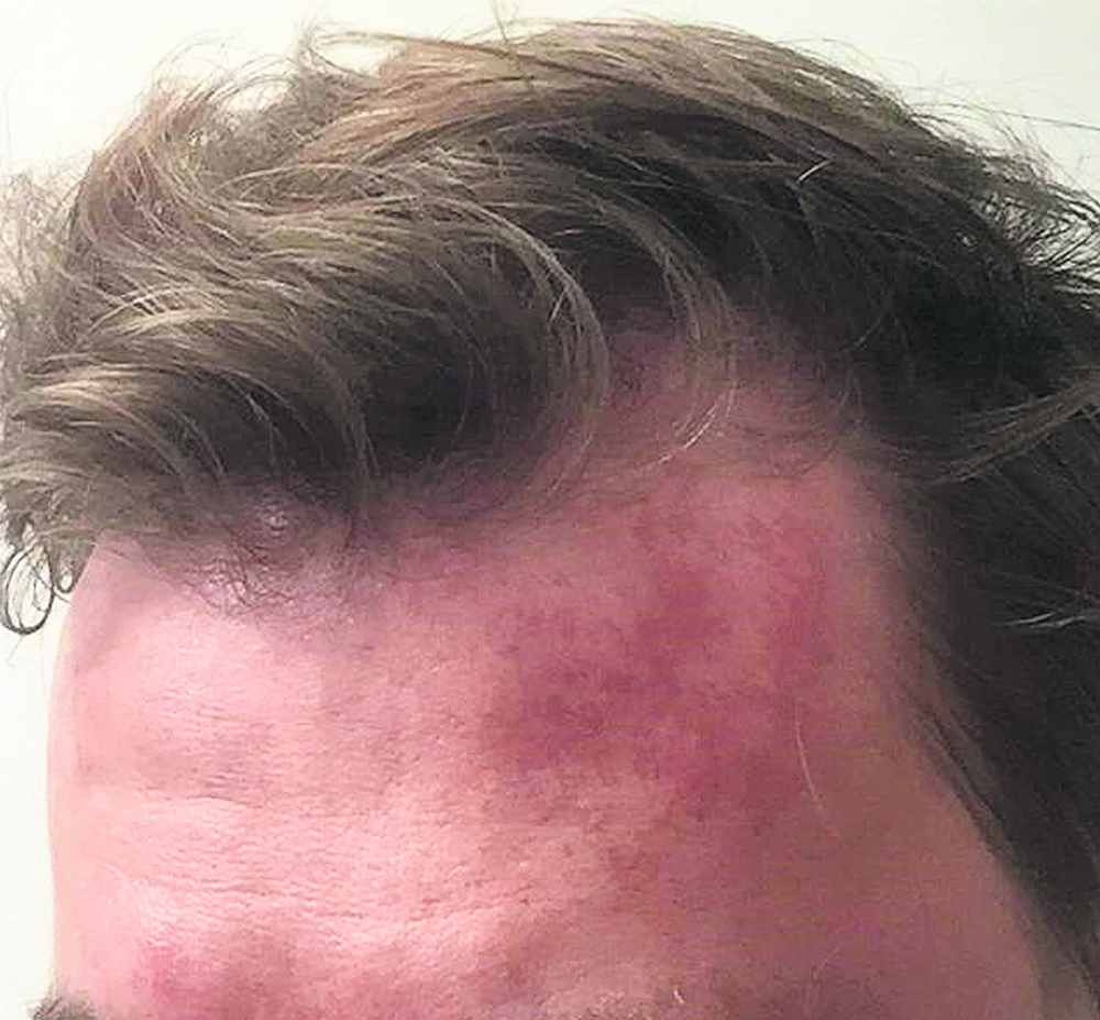 Gabriel sufrió una quemadura química en su cara y espalda. Foto: El País