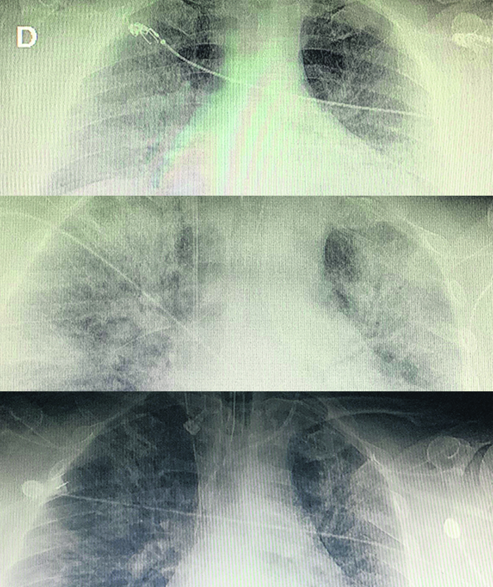 Radiografía de pulmones de un paciente con COVID-19. Arriba, al consultar al médico. Abajo, en vías de recuperación