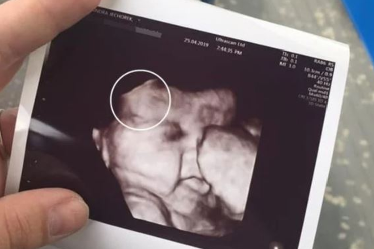 bebé con pelo largo desde las ecografías