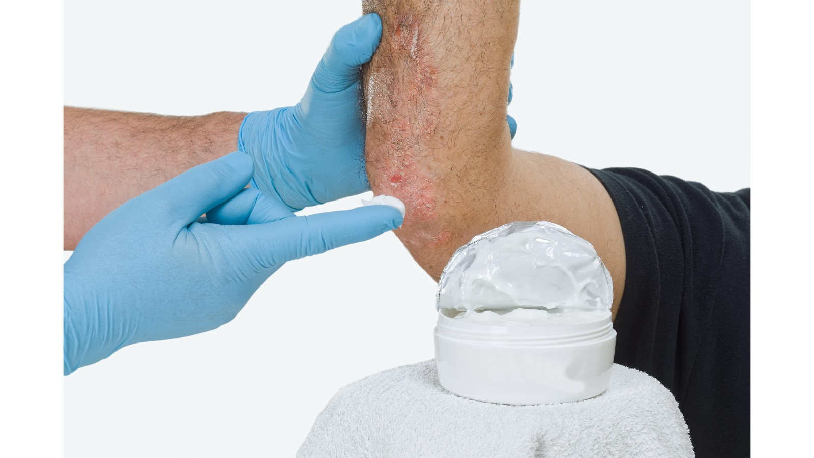 Psoriasis