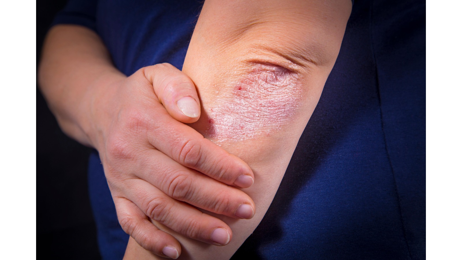 Psoriasis