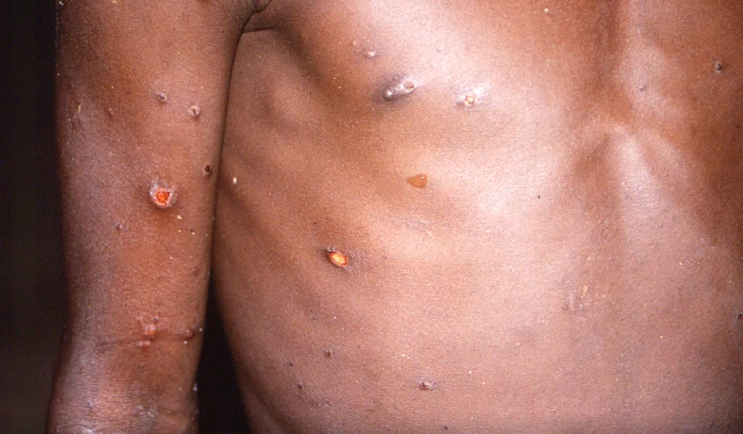 Viruela del mono. Foto: Captura de video de EFE