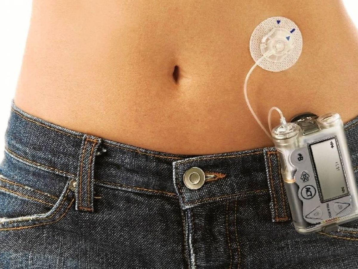 Bomba de insulina