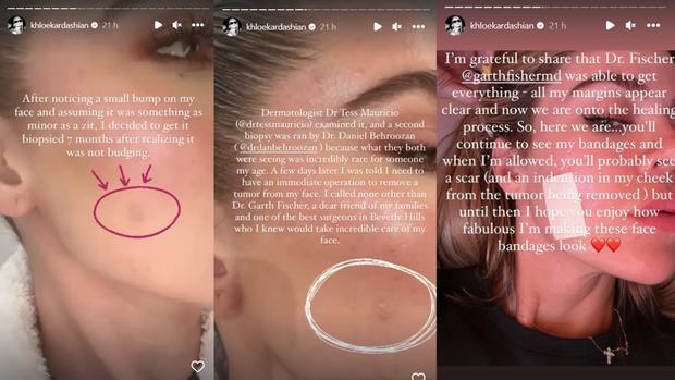 Khloe Kardashian fue operada de un tumor en la mejilla