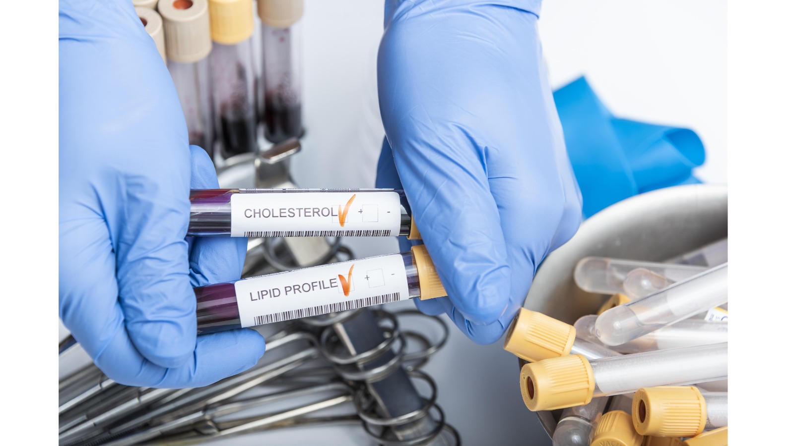 hipercolesterolemia familiar